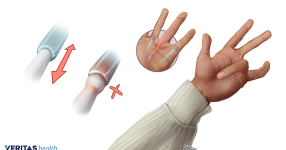 Trigger-Finger.png Trigger-Finger.png